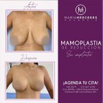 Dra. María Mercedes Valencia - Cirujanos Plásticos Certificados
