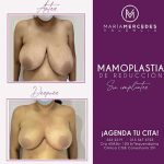 Dra. María Mercedes Valencia - Cirujanos Plásticos Certificados